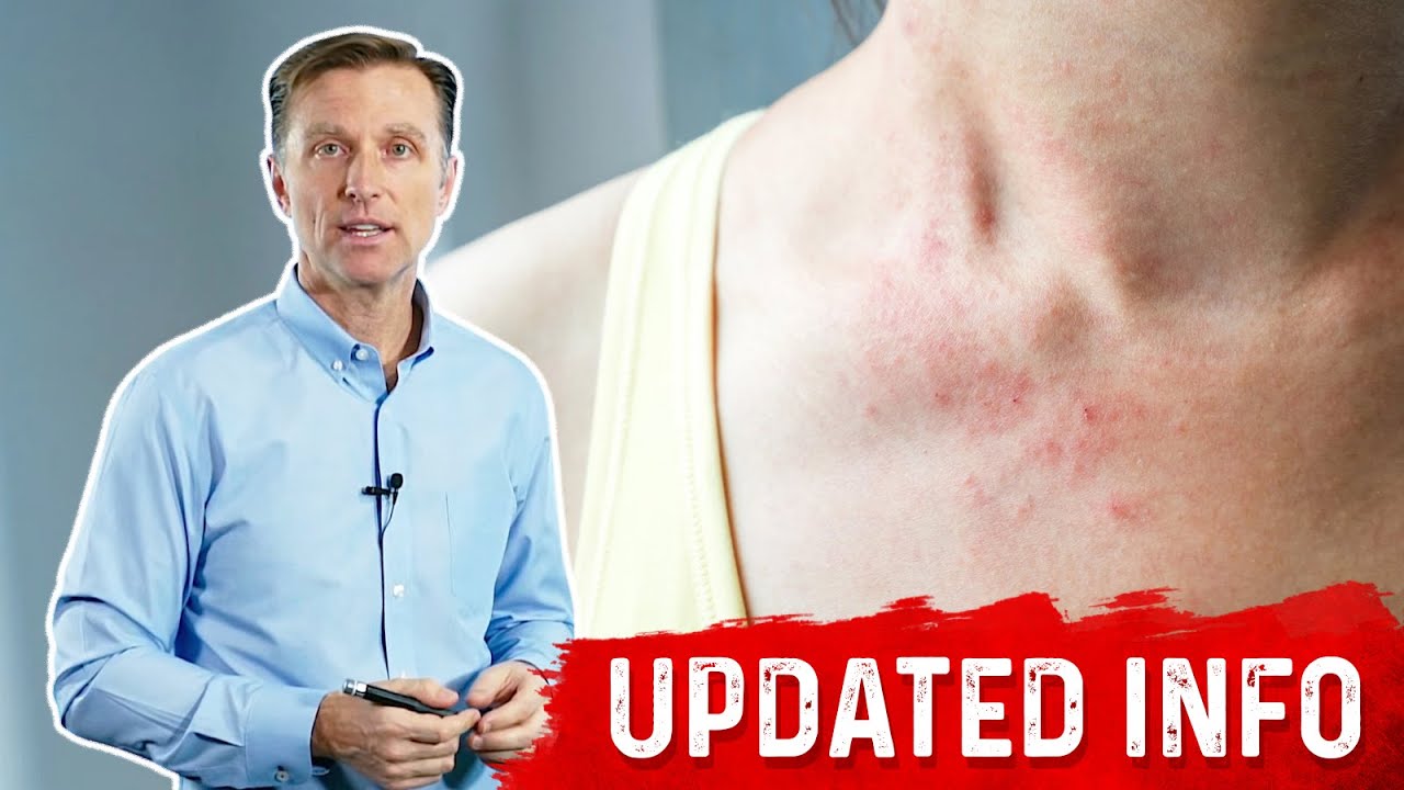 Effective Ways to Manage Keto Rash: Expert Tips for 2025!